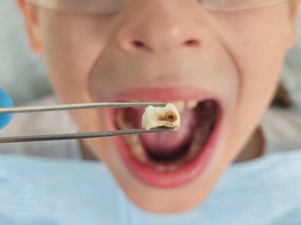 Best Emergency Dental Care for Abscessed Tooth in Stem, NC